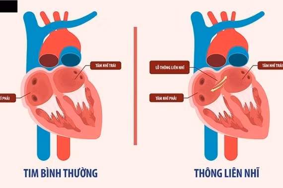 Tim bẩm sinh thông liên nhĩ ở người lớn điều trị thế nào?