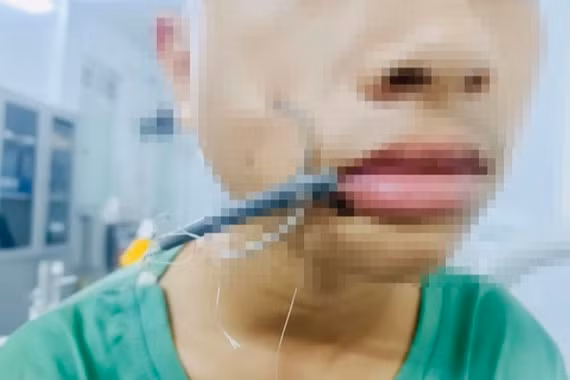 Bé trai bị lưỡi câu móc sâu vào mặt khi đi câu cá