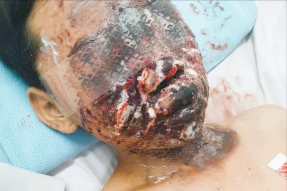 Trẻ 13 tuổi bỏng nặng vùng mặt, nguy cơ mất thị lực vĩnh viễn do pháo nổ