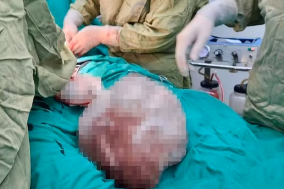 Hy hữu, bé gái 14 tuổi mang u buồng trứng hơn 4kg