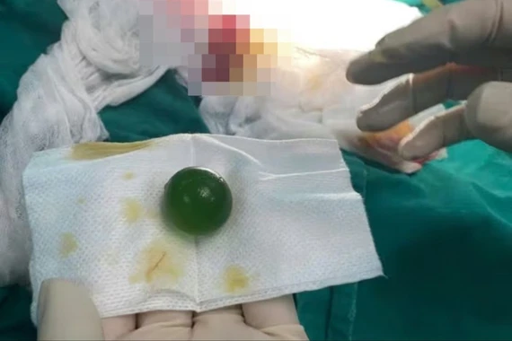 Cứu bé 13 tuổi nuốt phải viên hạt nở lớn tại Lào Cai