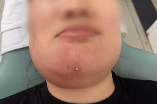 Người phụ nữ 37 tuổi mặt sưng vù, không ăn uống được vì tự ý nặn mụn