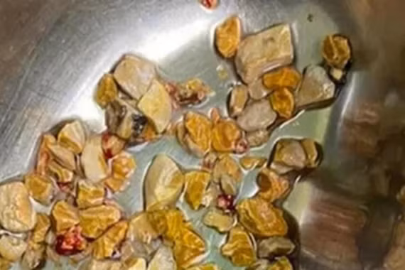 Các thực phẩm dễ gây sỏi thận 