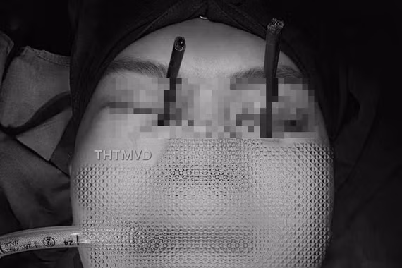 Hy hữu y khoa, 2 chiếc đũa đâm sâu vào 2 mắt trên cùng 1 người bệnh