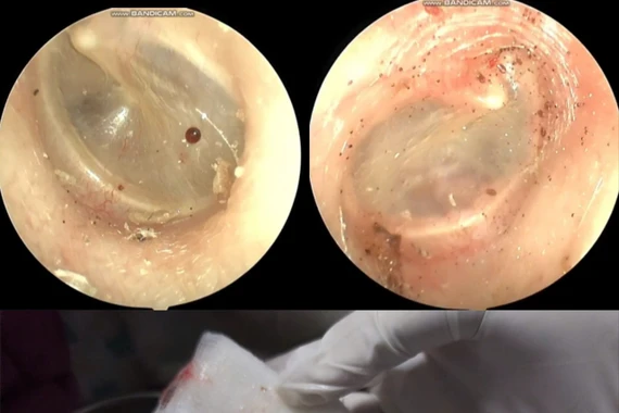 Bác sĩ gắp thành công bọ chó sống trong tai bệnh nhân 60 tuổi