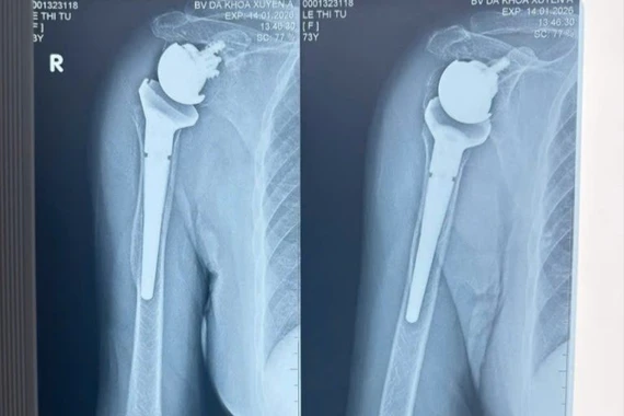 Khớp vai nhân tạo phục hồi khớp gãy nát sau tai nạn cho cụ bà 73 tuổi
