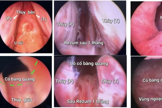 Kỹ thuật chữa bệnh lý tuyến tiền liệt 'xịn' nhất hiện nay
