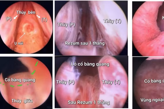Kỹ thuật chữa bệnh lý tuyến tiền liệt 'xịn' nhất hiện nay