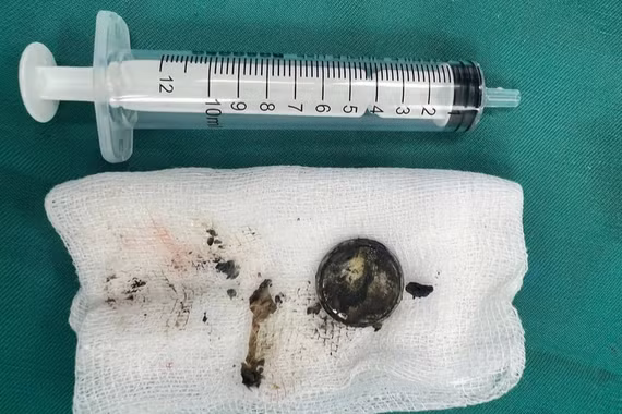 Bệnh nhi bị bỏng thực quản do nuốt phải pin cúc áo