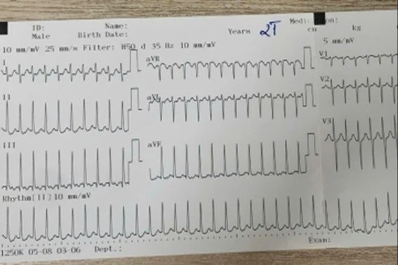 Tưởng mệt thông thường, không ngờ 2 tuổi nguy kịch vì nhịp nhanh trên thất