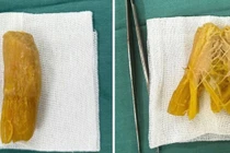 Tắc ruột, áp xe dạ dày do dị vật đường tiêu hóa hiếm gặp