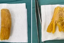 Tắc ruột, áp xe dạ dày do dị vật đường tiêu hóa hiếm gặp