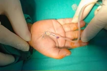 Vui chơi, trẻ ngã vào mảnh thủy tinh đứt nhiều gân ngón tay