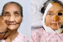 Loại bỏ khối u khổng lồ 40 năm trên mặt người phụ nữ dân tộc thiểu số