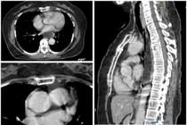 Nuốt nghẹn 6 tháng, nội soi lấy ra khối u mỡ thực quản kích thước khủng 