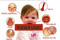 Sốt cao 5 ngày, bệnh nhi mắc bệnh lạ Kawasaki nguy hiểm
