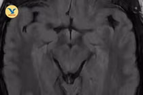 Nhìn mờ không ngờ huyết khối tĩnh mạch não