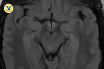 Nhìn mờ không ngờ huyết khối tĩnh mạch não