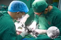 Bảo tồn thành công bàn tay bị vỡ, gãy nát phức tạp 