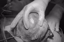 Bóc tách khối u buồng trứng nặng 5 kg cho người phụ nữ