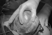 Bóc tách khối u buồng trứng nặng 5 kg cho người phụ nữ