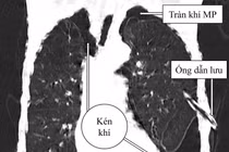 Cơn cấp bệnh phổi tắc nghẽn khiến người đàn ông bị vỡ kén khí nguy kịch