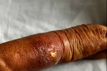 Tay hoại tử, biến dạng vì bó thuốc nam chữa gãy xương