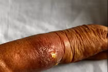 Tay hoại tử, biến dạng vì bó thuốc nam chữa gãy xương