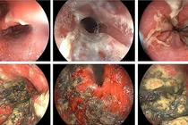 Uống rượu hoa quả tự ngâm, người đàn ông loét nặng từ miệng đến dạ dày