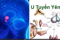 Tăng cân nhanh, béo bụng không ngờ u tuyến yên