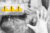 Bụng lớn bất thường, bé gái 13 tuổi mang u buồng trứng 8 kg