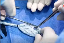 Lần đầu tiên đặt stent graft trổ lỗ zone 0 cứu ca bóc tách động mạch chủ 