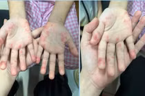 Tự dùng thuốc gút người bệnh dị ứng toàn thân nghiêm trọng