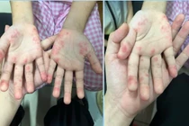 Tự dùng thuốc gút người bệnh dị ứng toàn thân nghiêm trọng