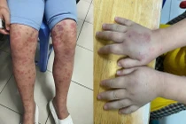 Nhiều trẻ bị ban xuất huyết biến chứng thận nguy hiểm 