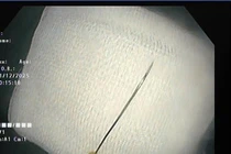 Chơi nhà hàng xóm, trẻ 11 tháng tuổi nuốt kim may 4cm vào trong tá tràng