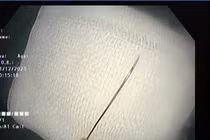 Chơi nhà hàng xóm, trẻ 11 tháng tuổi nuốt kim may 4cm vào trong tá tràng