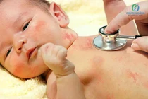 Lây thủy đậu từ mẹ, trẻ sơ sinh suy hô hấp cấp nguy kịch