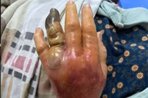 Bàn tay của bệnh nhân