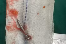 Súng bắn đinh bắn xuyên thành bụng, găm thủng ruột non