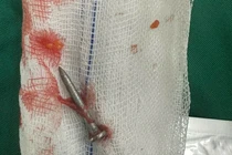 Súng bắn đinh bắn xuyên thành bụng, găm thủng ruột non