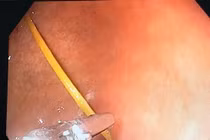 Thủng dạ dày vì thói quen ngậm tăm