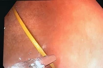 Thủng dạ dày vì thói quen ngậm tăm