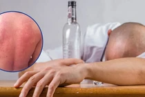 'Mẩn ngứa, nóng bừng' sau uống rượu bia, cẩn thận dị ứng tiềm ẩn nguy hiểm
