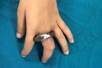 Ngón tay trẻ 6 tuổi sưng tím vì vòng khóa cửa