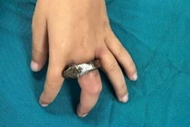 Ngón tay trẻ 6 tuổi sưng tím vì vòng khóa cửa