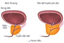 Kỹ thuật hiện đại điều trị tăng sinh tuyến tiền liệt