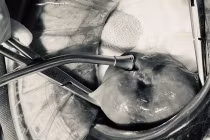 Đau bụng, táo bón cụ bà 74 tuổi ở Hà Nội nguy kịch do thủng tử cung