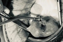 Đau bụng, táo bón cụ bà 74 tuổi ở Hà Nội nguy kịch do thủng tử cung