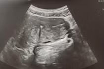 Tháo vòng cắm sâu vào cơ tử cung không cần mổ